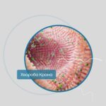 В Институте Шалимова рассказали об основных признаках болезни Крона