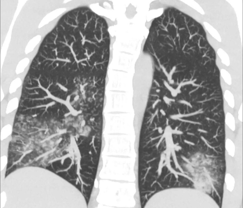 В Украине зафиксировано 13 случаев опасного метапневмовируса: кто в зоне риска
