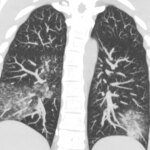 В Украине зафиксировано 13 случаев опасного метапневмовируса: кто в зоне риска