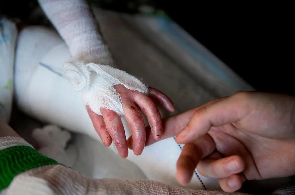 Международная практика лечения «людей-бабочек» обновляется, но в Украине застыла во времени