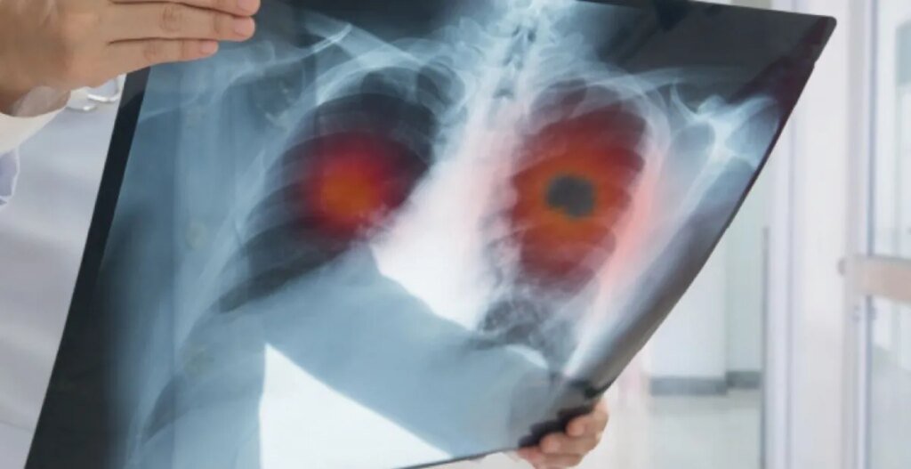 Диагностирование рака легких растет среди людей, которые никогда не курили: ученые ищут причину