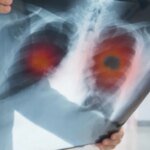 Диагностирование рака легких растет среди людей, которые никогда не курили: ученые ищут причину
