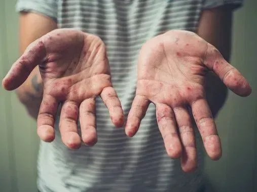 Заболеваемость корью в ближайшие недели, скорее всего, будет расти — иммунолог