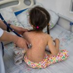 Корь в Европе: ВОЗ сообщает об удвоении случаев на фоне падения вакцинации после COVID