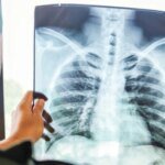 В ЦОЗ Минздрава опровергли миф о туберкулезе