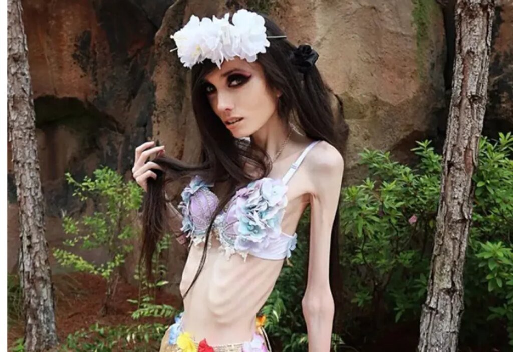 Франция обеспокоена продвижением анорексии в TikTok под #SkinnyTok