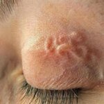 Во Львове врачи извлекли из глаза пациента 12-сантиметрового глиста, который попал в организм после укуса комара