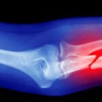 Ученые доказали, что микропластик разрушает кости и способствует остеопорозу