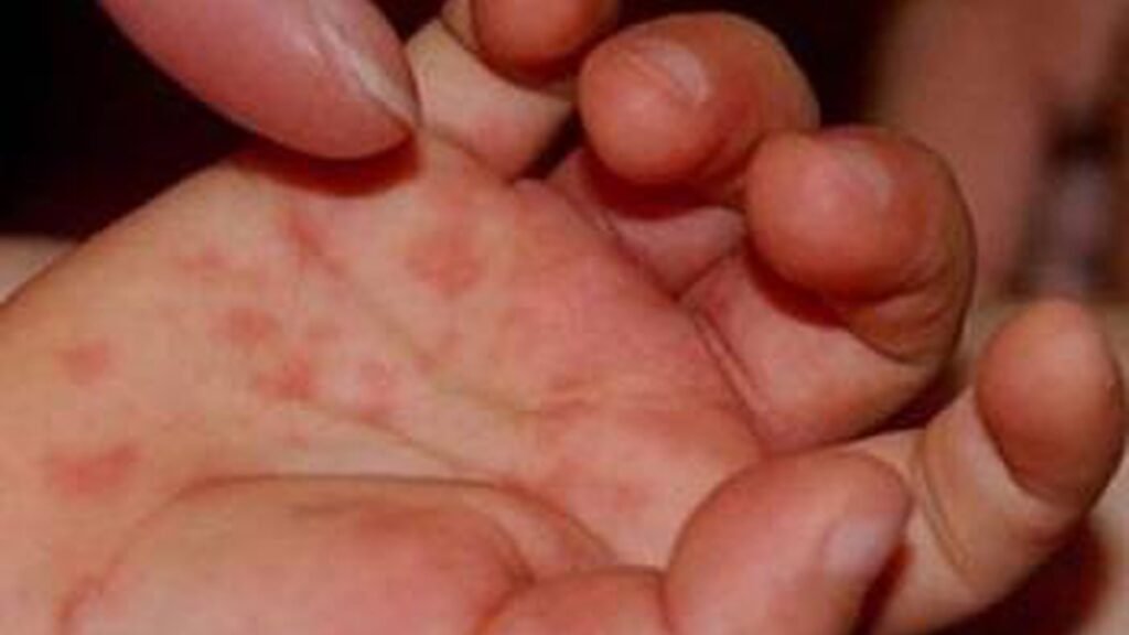 Заболеваемость корью в Украине существенно возросла, с начала года зарегистрировано почти 1200 случаев