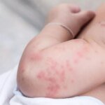 После COVID-19 развилось опасное поражение кожи: медики спасли младенца из Львовской области