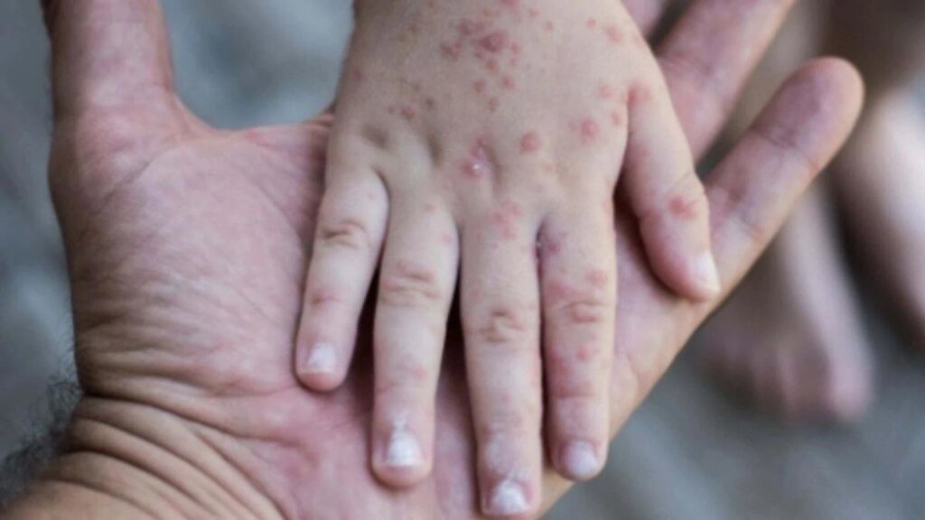 Вспышка болезни Коксаки на Киевщине: 13 детей заболели, один до сих пор в больнице