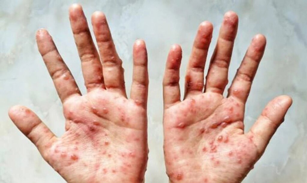 Новый штамм оспы обезьян обнаружен в Британии