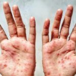 Новый штамм оспы обезьян обнаружен в Британии