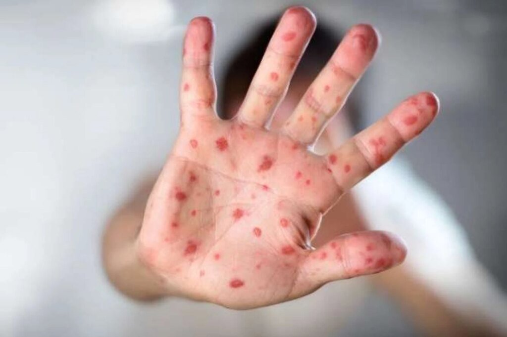 В гимназии Днепра зафиксирована вспышка кори: заболели трое детей из одного класса