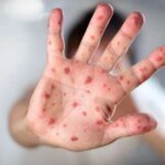 В гимназии Днепра зафиксирована вспышка кори: заболели трое детей из одного класса