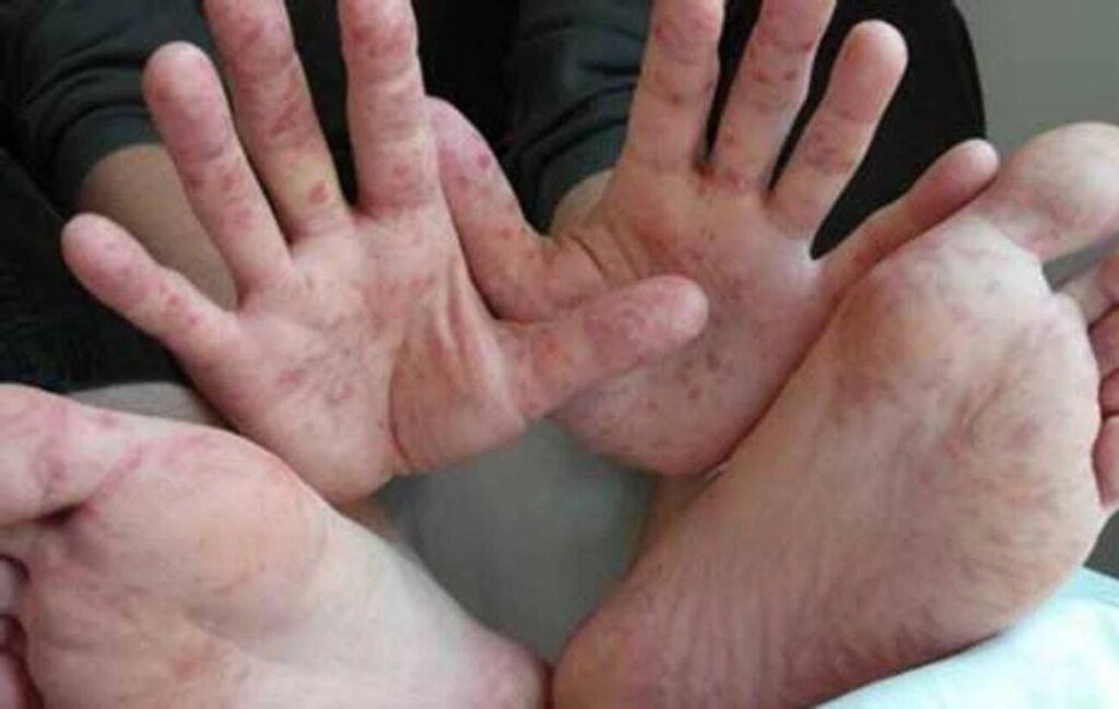 Рука-нога-рот или вирус Коксаки — как им заражаются люди и чем опасна инфекция